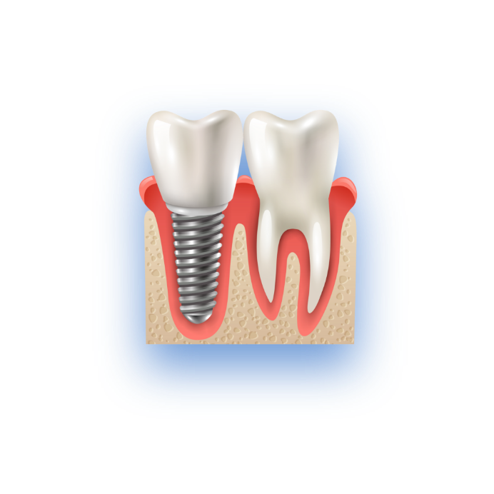 tooth implant