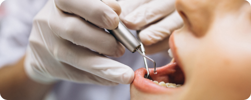 root canal process 2