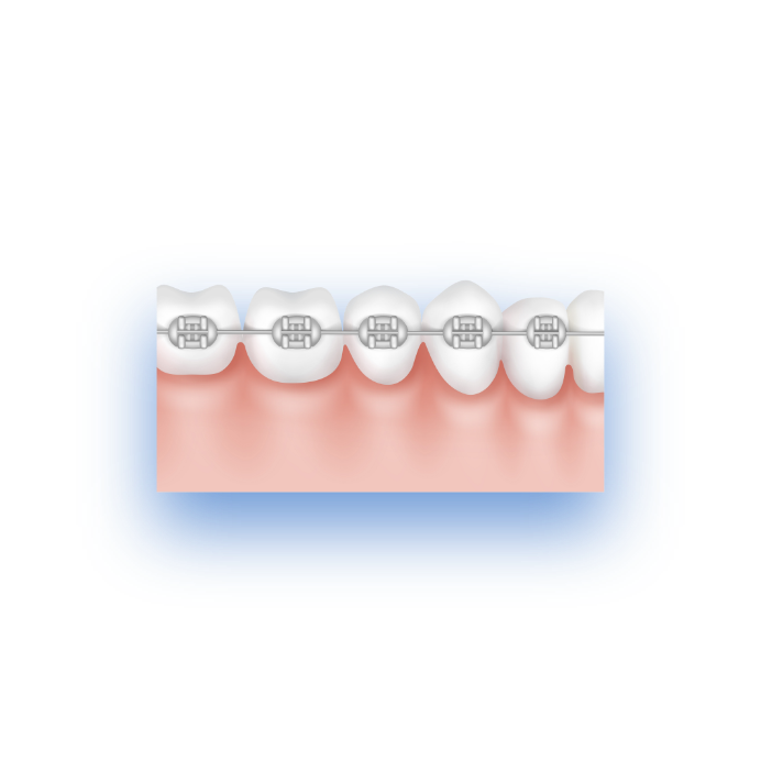 dental braces