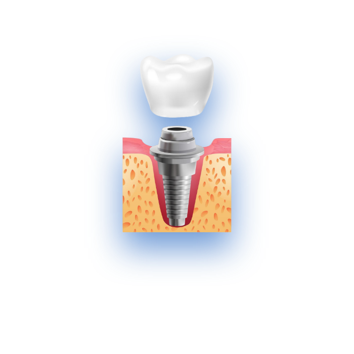 dental crown