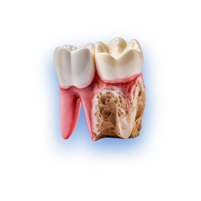 root canal